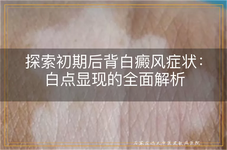 探索初期后背白癜风症状：白点显现的全面解析