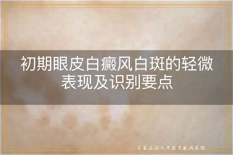 初期眼皮白癜风白斑的轻微表现及识别要点
