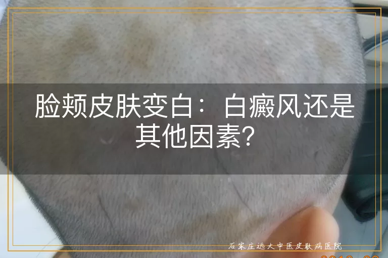 脸颊皮肤变白：白癜风还是其他因素？