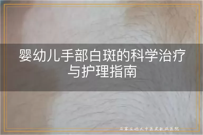 婴幼儿手部白斑的科学治疗与护理指南