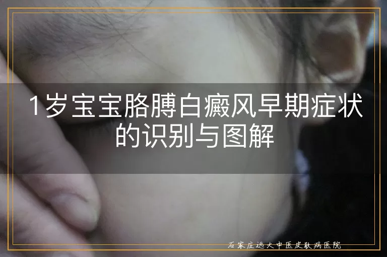 1岁宝宝胳膊白癜风早期症状的识别与图解