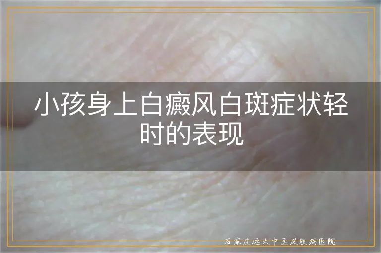 小孩身上白癜风白斑症状轻时的表现