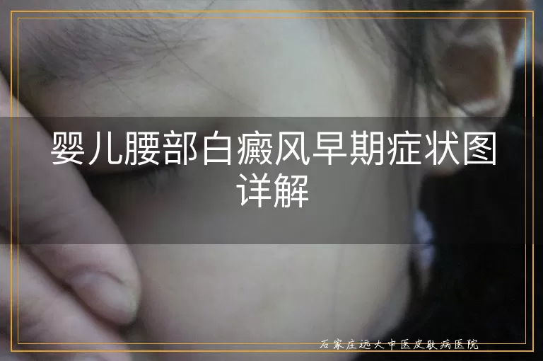 婴儿腰部白癜风早期症状图详解