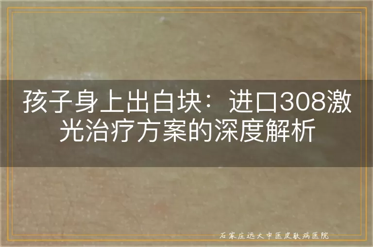 孩子身上出白块：进口308激光治疗方案的深度解析