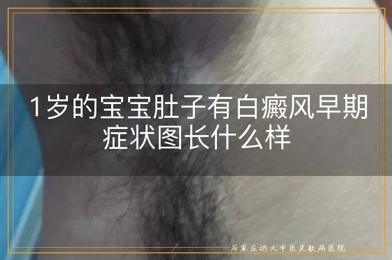 1岁的宝宝肚子有白癜风早期症状图长什么样