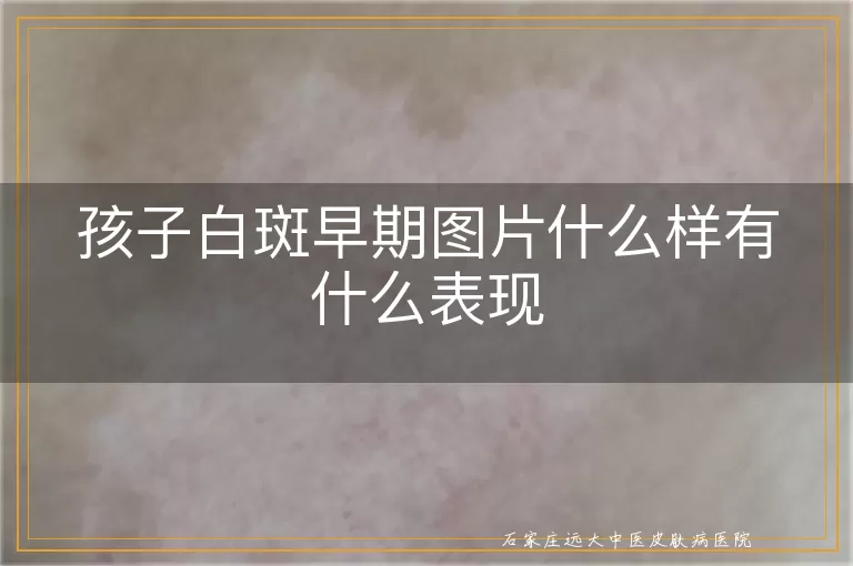 孩子白斑早期图片什么样有什么表现