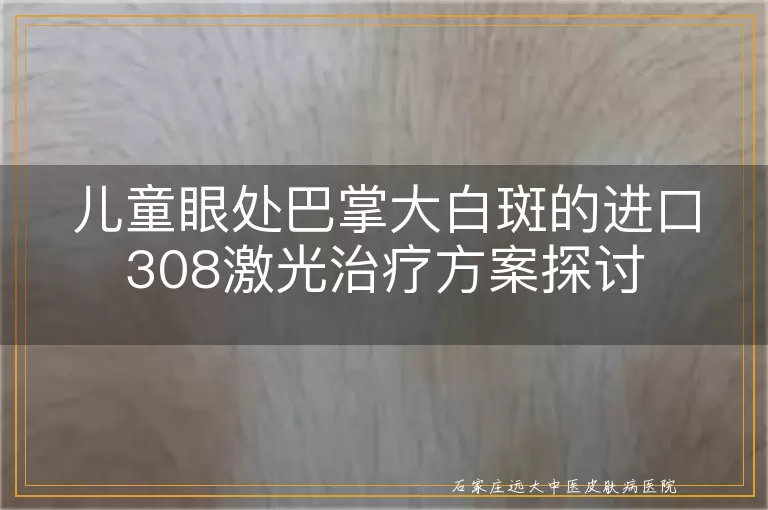 儿童眼处巴掌大白斑的进口308激光治疗方案探讨