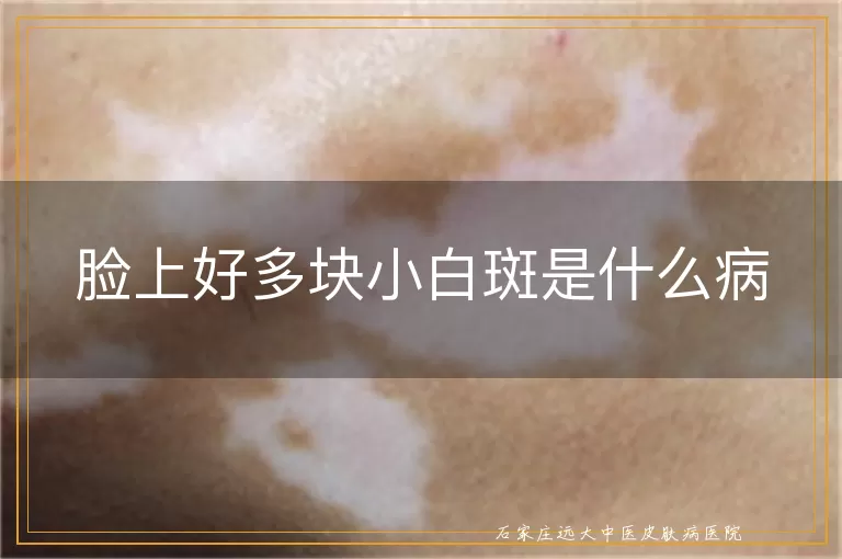 脸上好多块小白斑是什么病