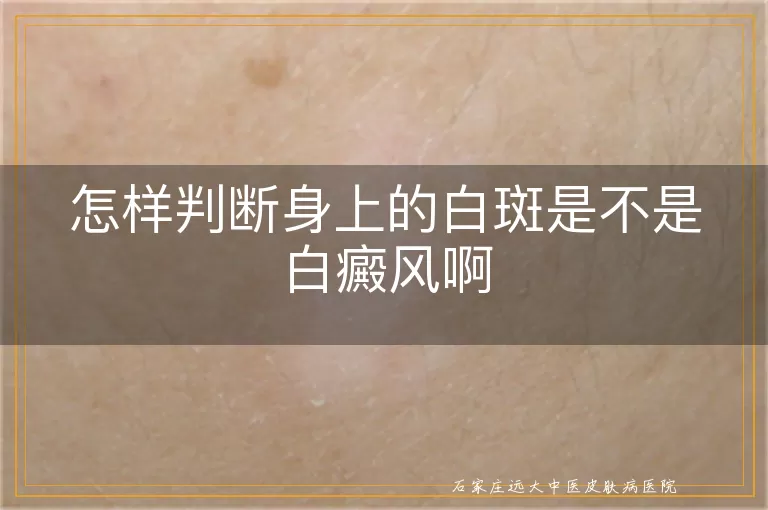怎样判断身上的白斑是不是白癜风啊