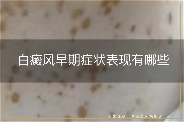 白癜风早期症状表现有哪些