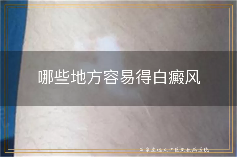 哪些地方容易得白癜风