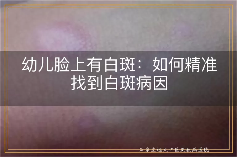 幼儿脸上有白斑：如何精准找到白斑病因