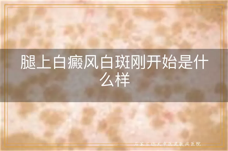 腿上白癜风白斑刚开始是什么样