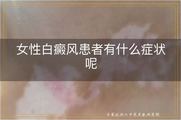 女性白癜风患者有什么症状呢