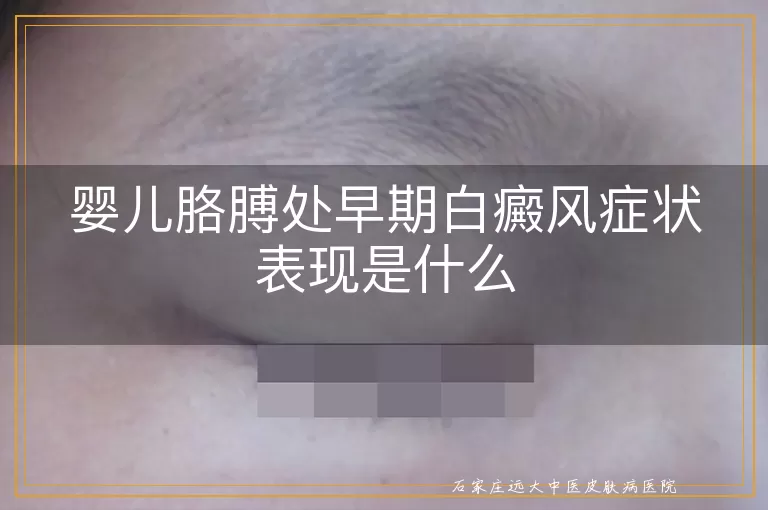 婴儿胳膊处早期白癜风症状表现是什么