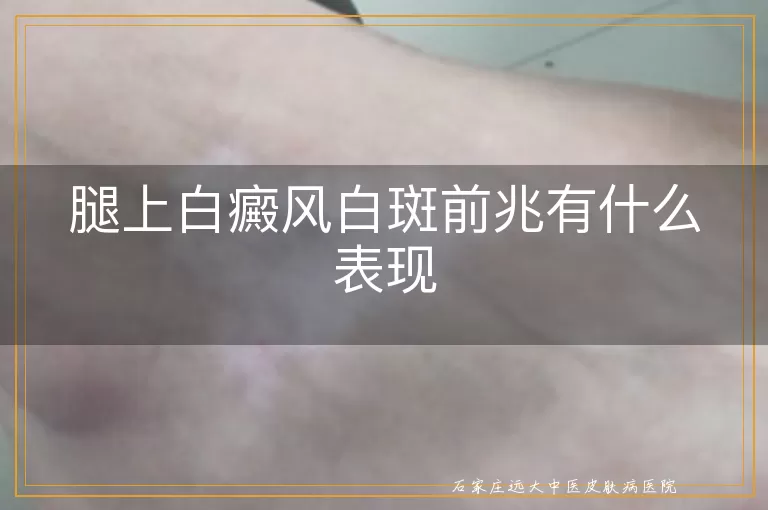 腿上白癜风白斑前兆有什么表现