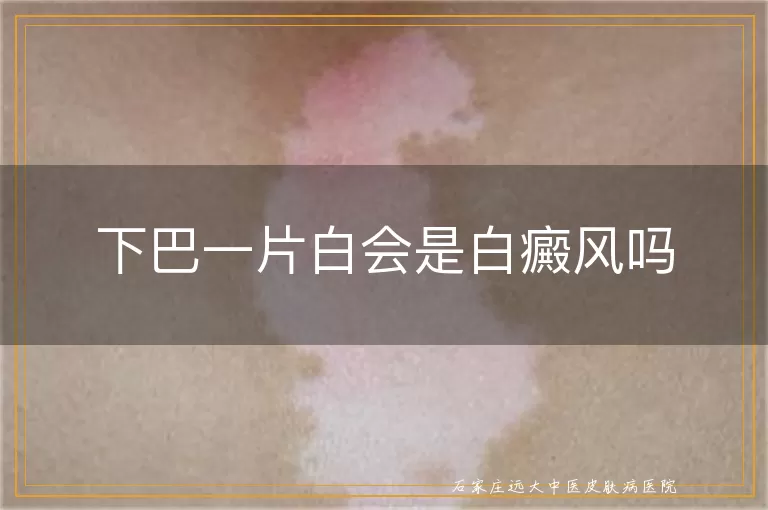 下巴一片白会是白癜风吗
