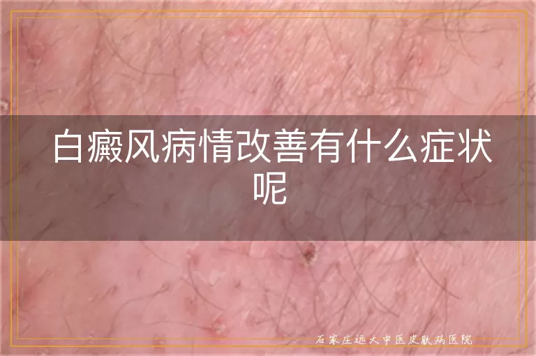白癜风病情改善有什么症状呢