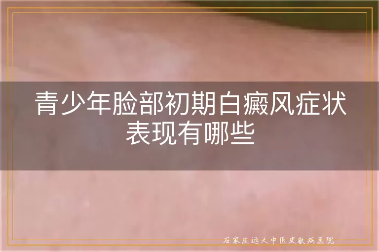 青少年脸部初期白癜风症状表现有哪些
