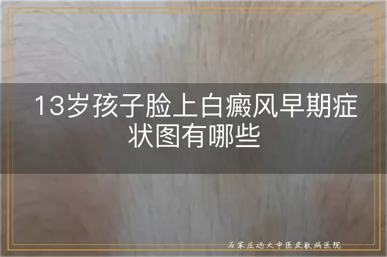 13岁孩子脸上白癜风早期症状图有哪些