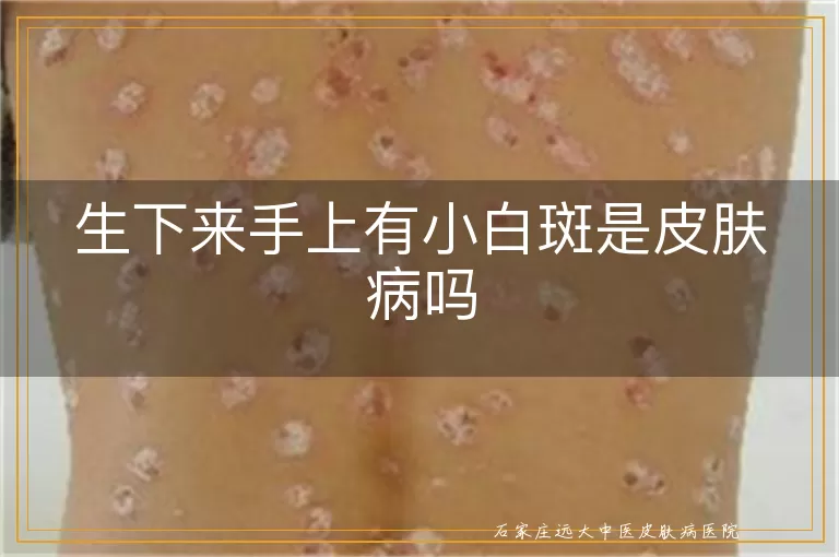 生下来手上有小白斑是皮肤病吗