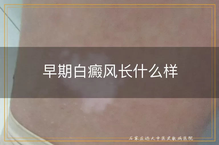 早期白癜风长什么样