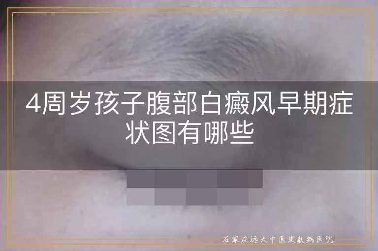 4周岁孩子腹部白癜风早期症状图有哪些
