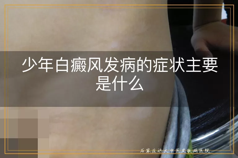 少年白癜风发病的症状主要是什么