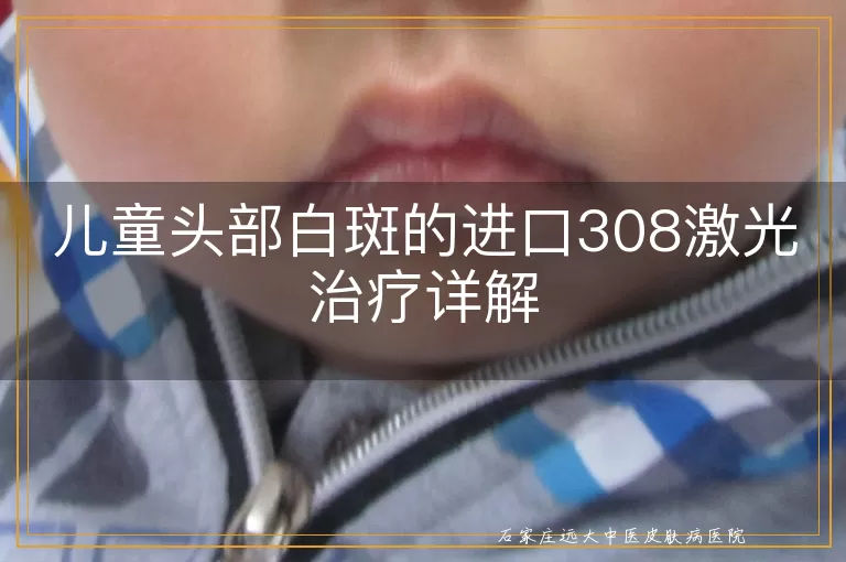 儿童头部白斑的进口308激光治疗详解