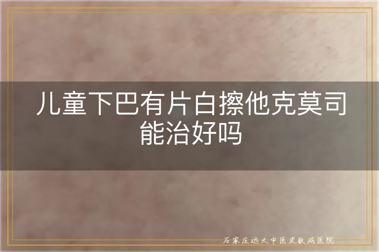 儿童下巴有片白擦他克莫司能治好吗