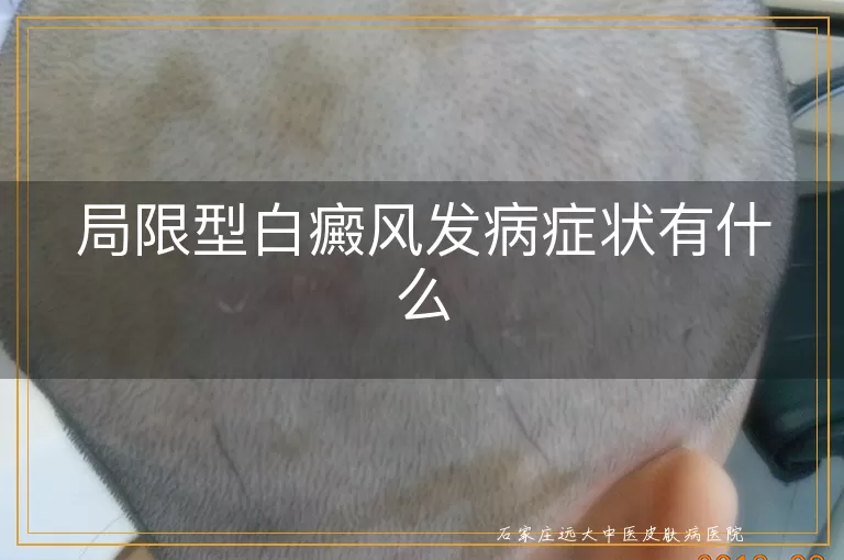 局限型白癜风发病症状有什么