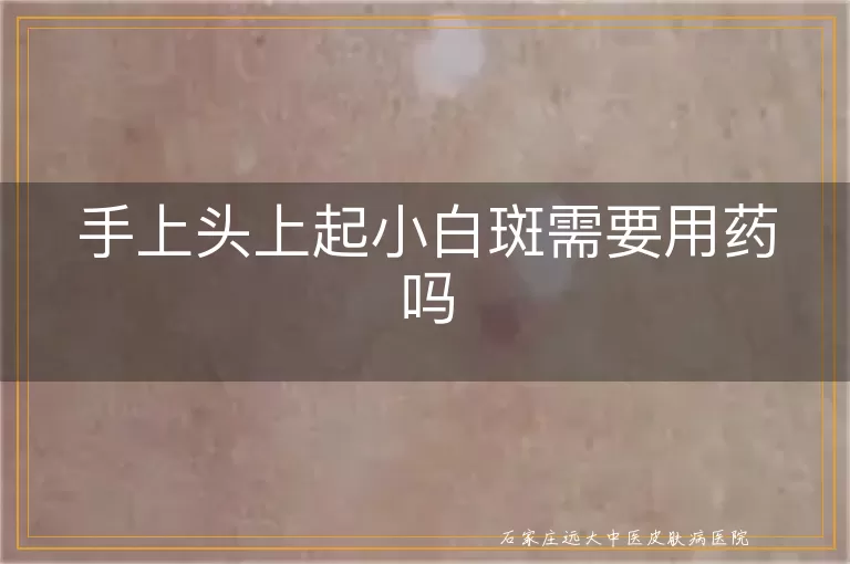 手上头上起小白斑需要用药吗