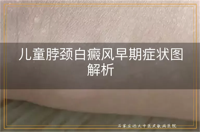 儿童脖颈白癜风早期症状图解析