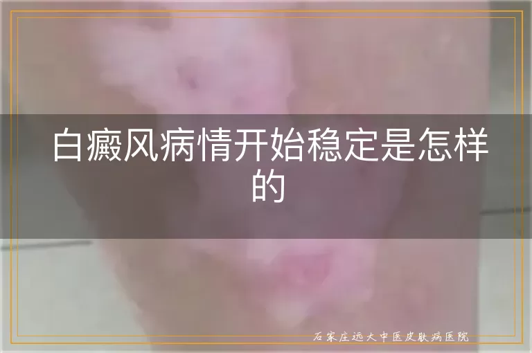 白癜风病情开始稳定是怎样的
