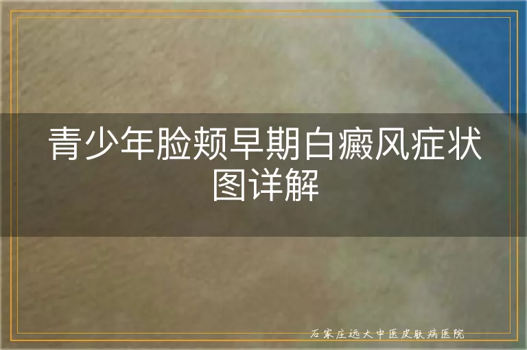 青少年脸颊早期白癜风症状图详解