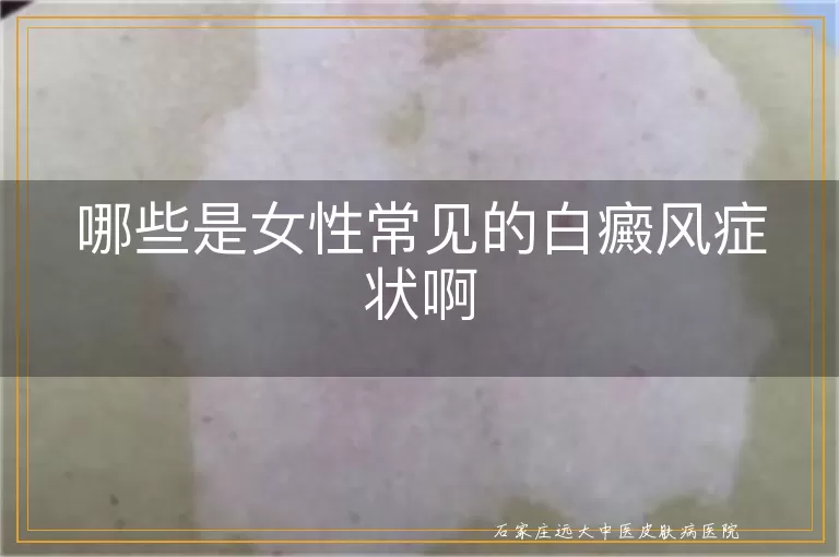 哪些是女性常见的白癜风症状啊