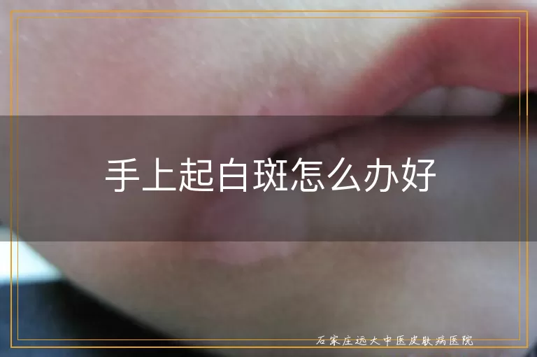 手上起白斑怎么办好