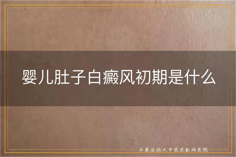 婴儿肚子白癜风初期是什么