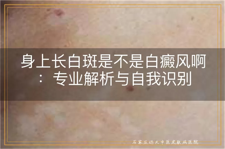 身上长白斑是不是白癜风啊：专业解析与自我识别