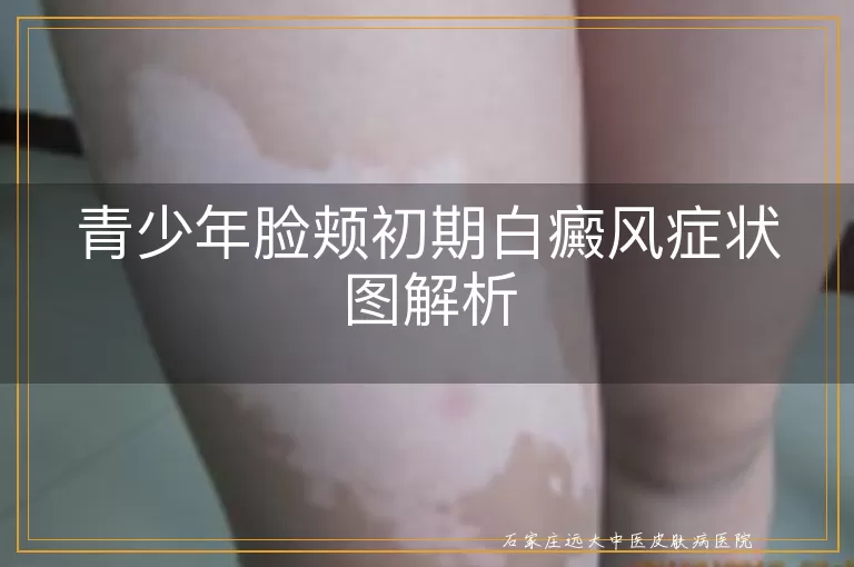 青少年脸颊初期白癜风症状图解析