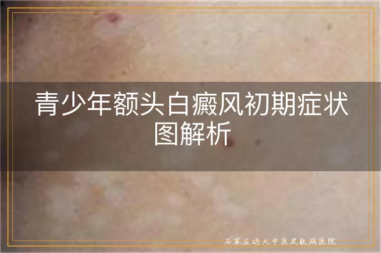 青少年额头白癜风初期症状图解析