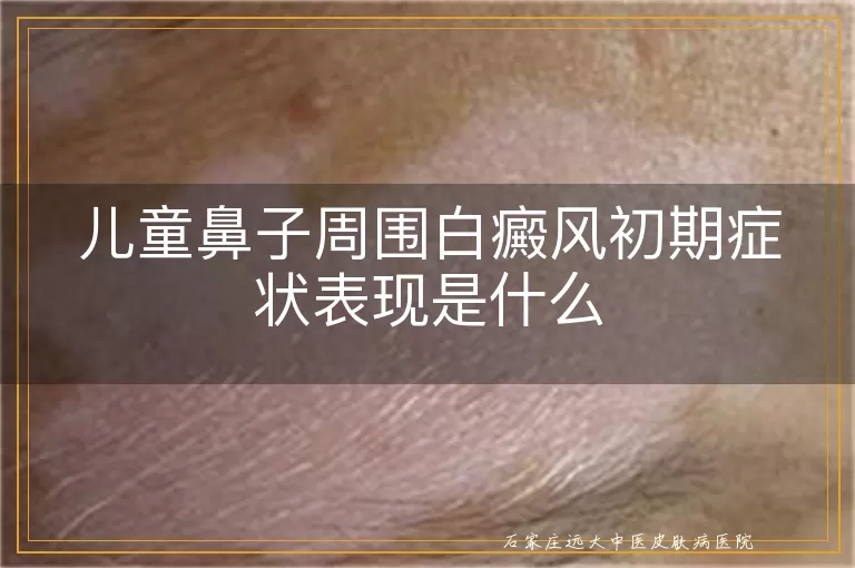 儿童鼻子周围白癜风初期症状表现是什么