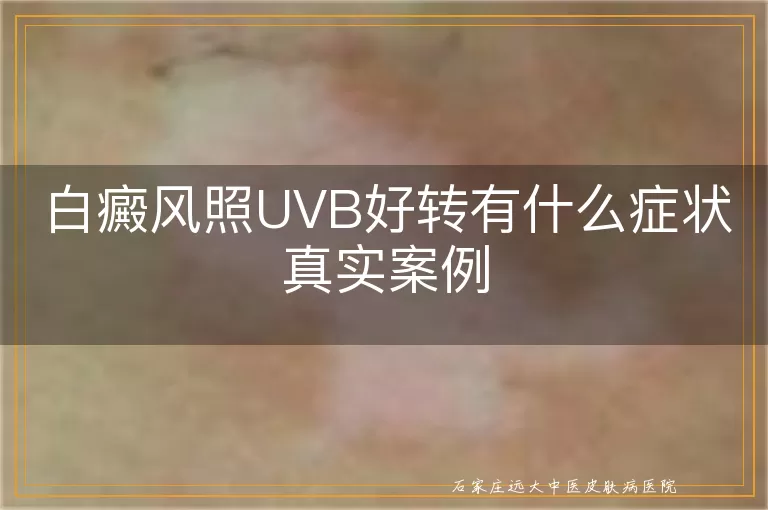 白癜风照UVB好转有什么症状真实案例