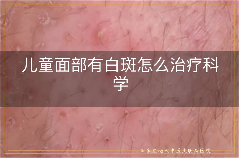 儿童面部有白斑怎么治疗科学