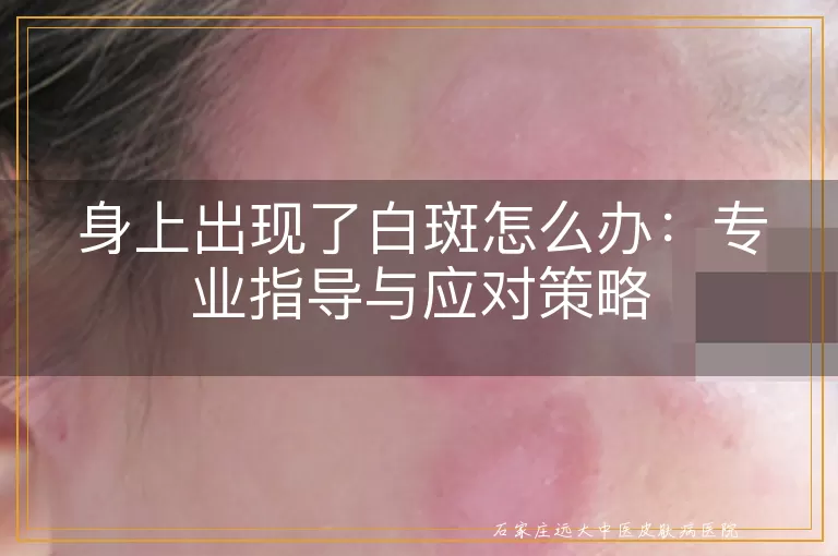 身上出现了白斑怎么办：专业指导与应对策略