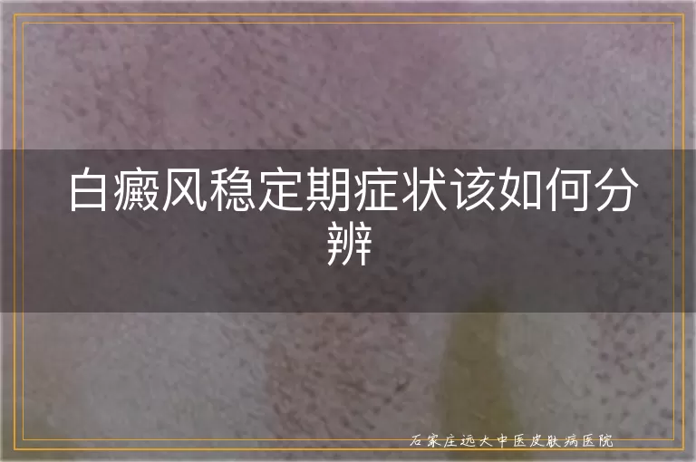白癜风稳定期症状该如何分辨