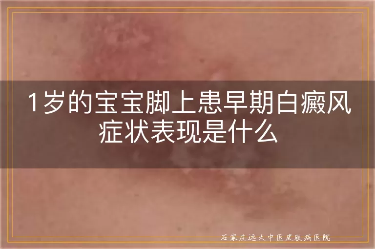 1岁的宝宝脚上患早期白癜风症状表现是什么
