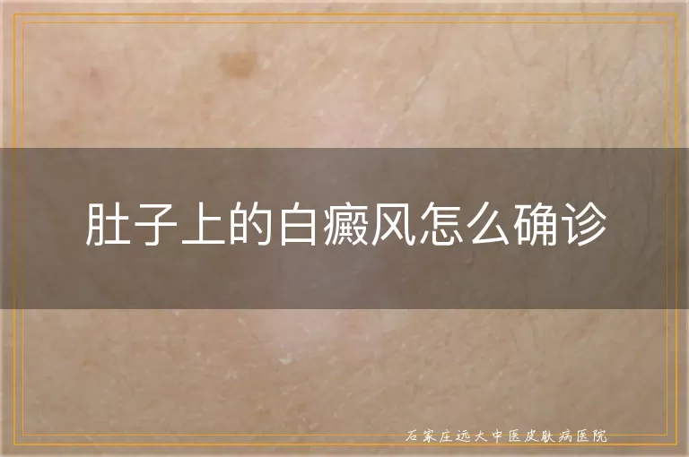 肚子上的白癜风怎么确诊