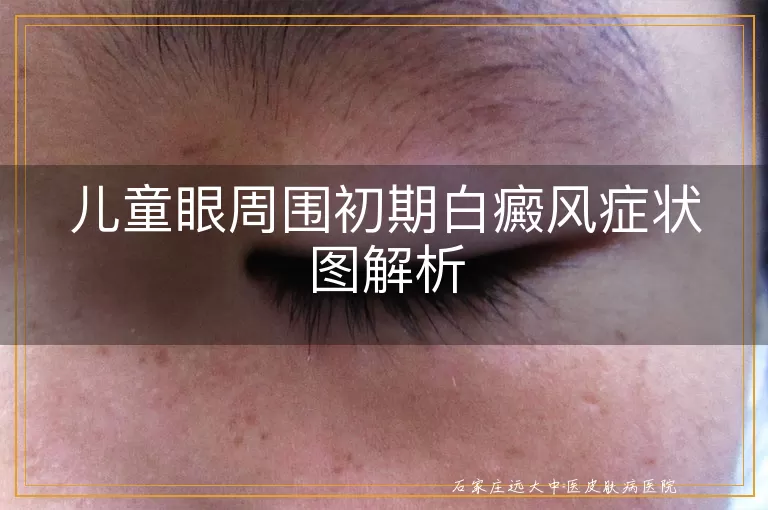 儿童眼周围初期白癜风症状图解析