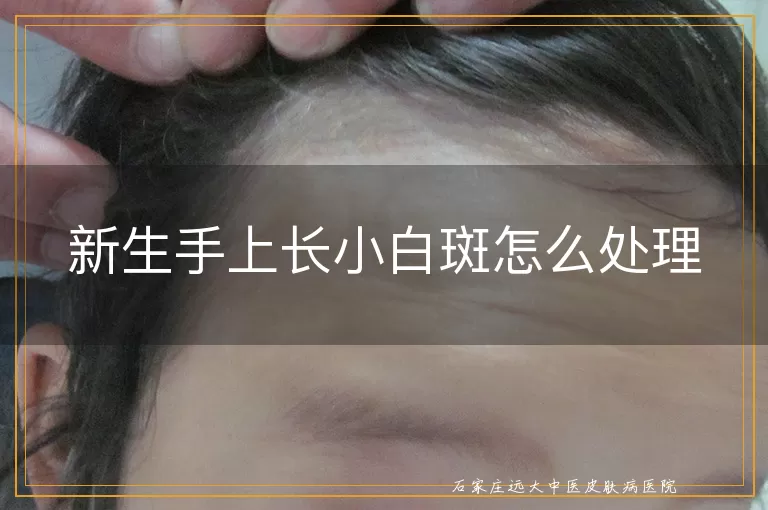 新生手上长小白斑怎么处理